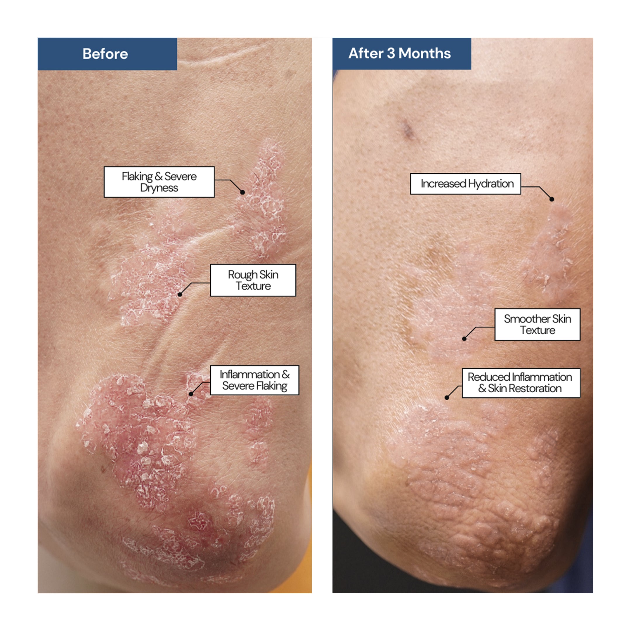 THE REPAIR - E ECZEMA Moisturizer – SKIN IN ORDER